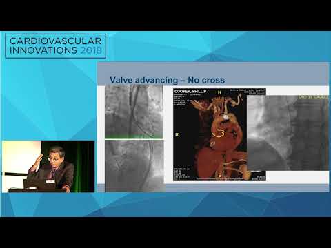 CVI2018 Session: How I managed a difficult Sapien case - Samir Kapadia, MD
