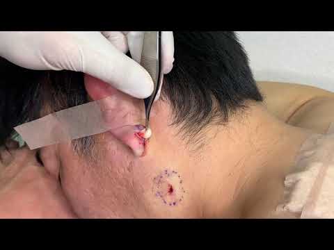 Earlobe Cyst Removal
