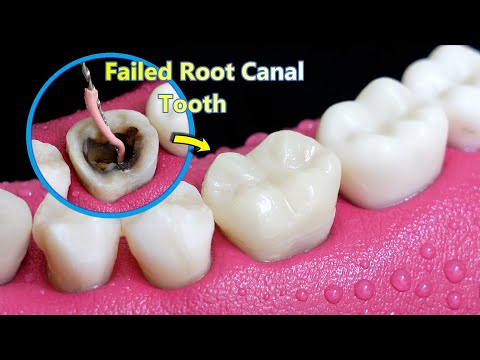 Reconstruction Of Poor/Failed Root Canal Treated Tooth