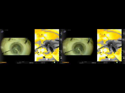 Alcon Ngenuity 3D Thermoimaging in  PiP mode