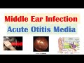 Middle Ear Infection (Acute Otitis Media) | Causes, Symptoms, Diagnosis, Treatment