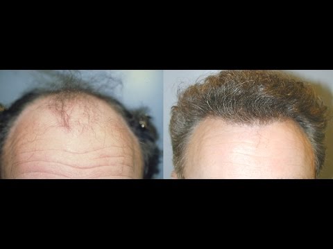 Neograft | Watch the Procedure with Before and After Photos #neograft #hairtransplant