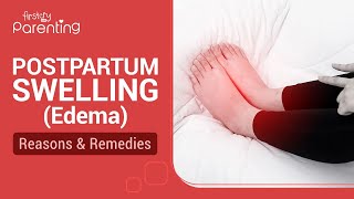Postpartum Swelling (Edema) - Reasons and Remedies