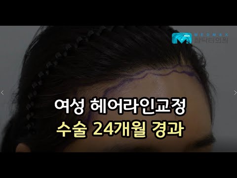 여성 헤어라인교정 모발이식 24개월 경과 [메드맥스 참닥터]