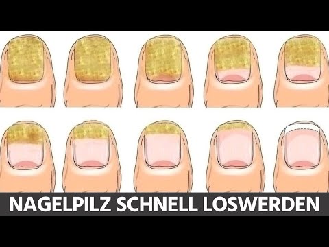5 Hausmittel, mit denen du Nagelpilz in wenigen Tagen loswirst!