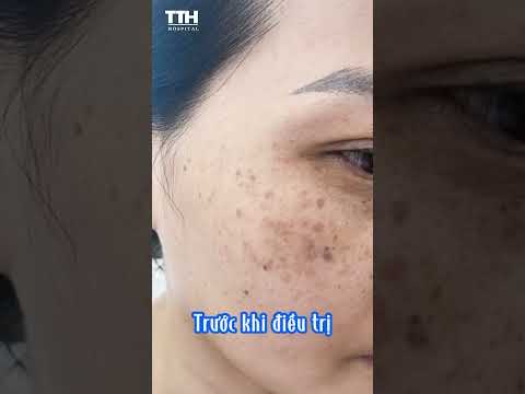 Hiệu quả điều trị NÁM - TÀN NHANG bằng Laser công nghệ cao| Bệnh viện Thái Thượng Hoàng #shorts