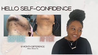Electrolysis Changed My Life | Best Solution for Hirsutism Ingrown Hairs and PCOS