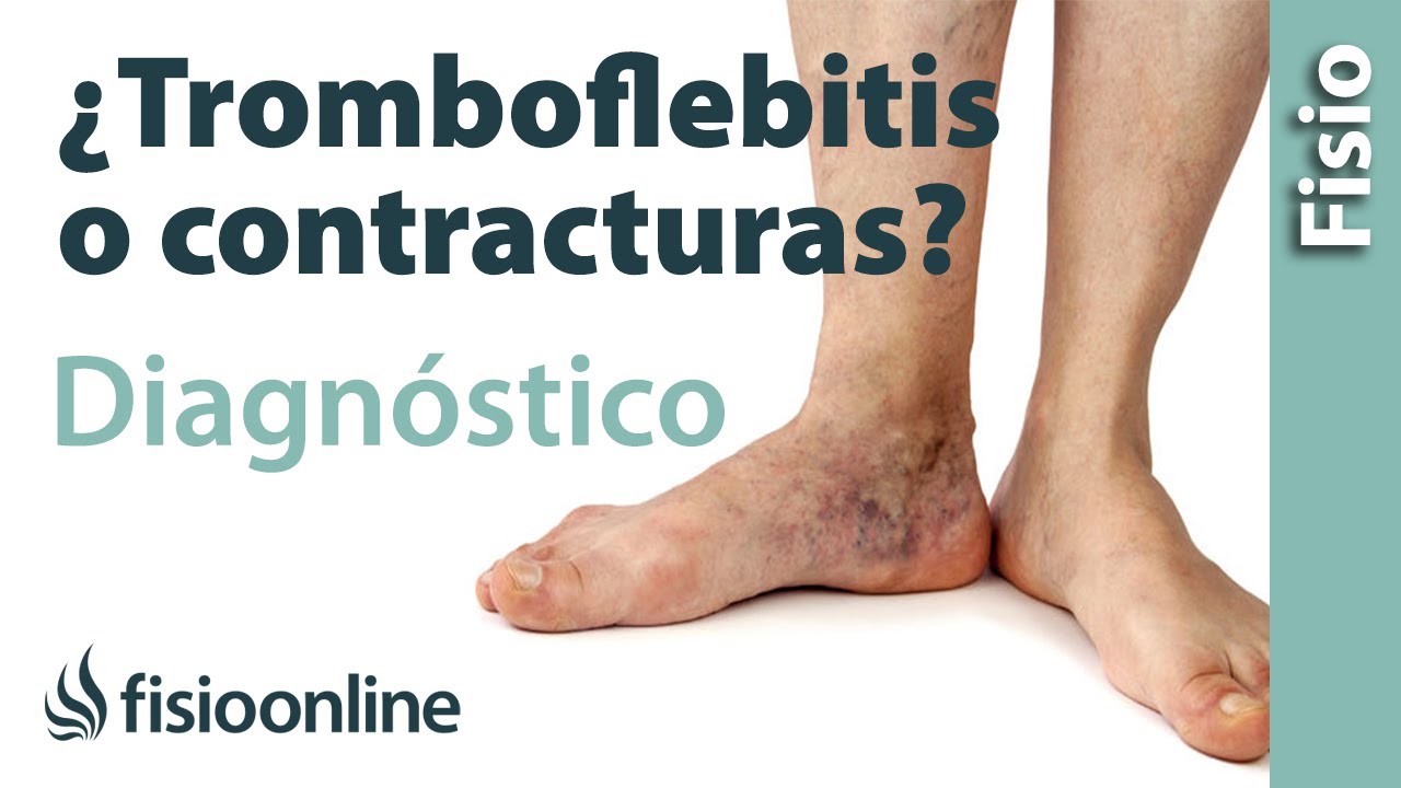 Cómo diferenciar una tromboflebitis de un dolor muscular  de la pantorrilla o contractura muscular