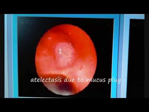 Atelectasis Or Pleural Effusion