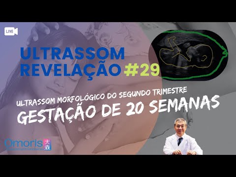 LIVE MORPHOLOGICAL ULTRASOUND: How it's done - Pregnancy 20 weeks - Baby gender reveal #28