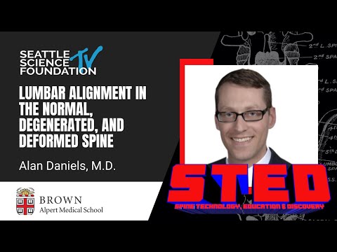 Lumbar Alignment in the Normal, Degenerated, and Deformed Spine – Alan Daniels, MD