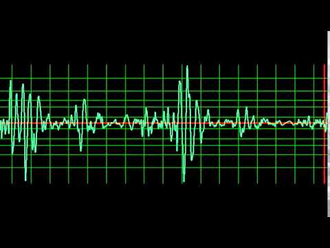 Infective Endocarditis Mitral Regurgitation- slow