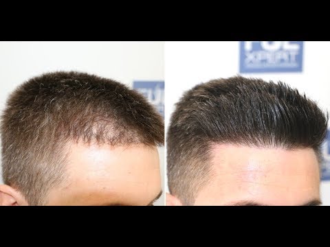 FUE Hair Transplant Repair (705 Grafts) By Dr Juan...