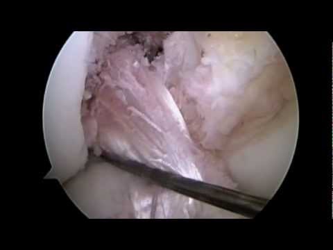 Artroskopowa rekonstrukcja więzadła krzyżowego przedniego