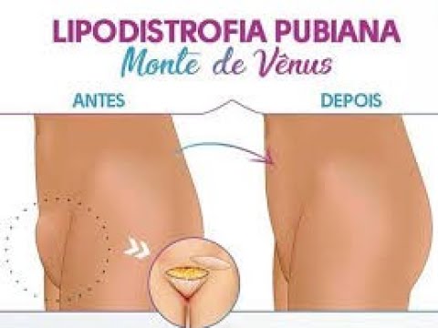 download lagu mp3 mp4 Monte De Venus Liposuccion, download lagu Monte De Venus Liposuccion gratis, unduh video klip Monte De Venus Liposuccion