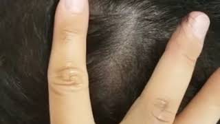 Healed Scalp Micropigmentation density restoration for thinning hair