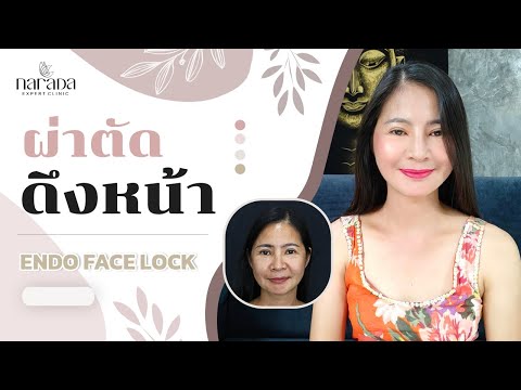 ผ่าตัดดึงหน้า Endo Face Lockโชว์รอยแผลหลังทำ ที่ นารดาคลินิก