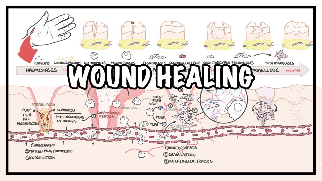 Wound Healing - Stages of healing and pathology