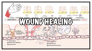 Wound Healing - Stages of healing and pathology