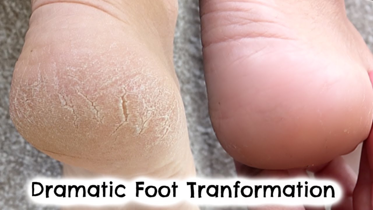 DRAMATIC FOOT TRANSFORMATION IN 10 DAYS | HOW I FIXED MY DRY, CRACKED HEELS | KERRY WHELPDALE