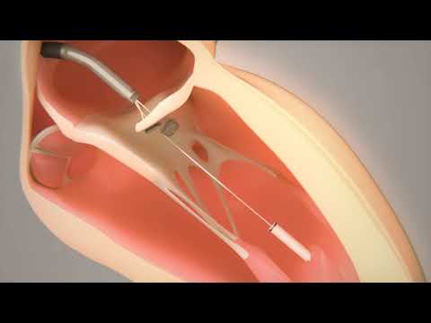 Transcatheter Mitral Valve Chord Repair by Pipeline Medical