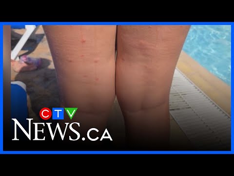 Family's Cuban vacation turns to bed-bug ridden nightmare