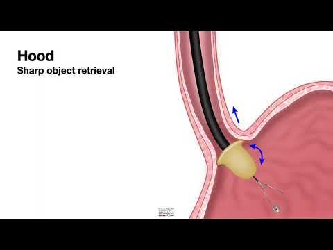 HCC 1472-Lesson 12e-Foreign Body Retrieval-Hood