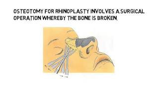 preview picture of video 'What is Osteotomy?'