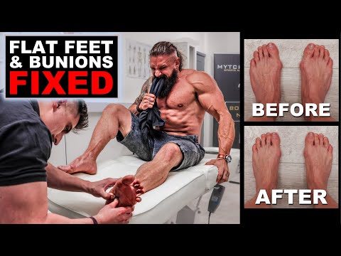 The WORST PAIN | Fixing BUNIONS & FLAT FEET Without Surgery! | Trigger Point Therapy (Lex Fitness)