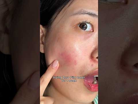 #zerofilm #zerofilmchallenge #orien #spraytoner #acnemarks #koreanskincare #kbeauty