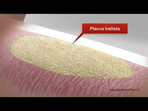 Effetto enalapril sulla potenza Il che significa aumentare la potenza del più