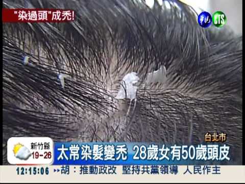 染髮過度傷頭皮 30歲女子禿頭