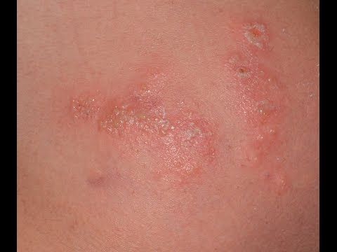 Fürdés után vörös foltokkal rendelkező bőr