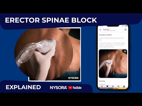 Erector Spinae Plane Block (ESP): When, How & Why