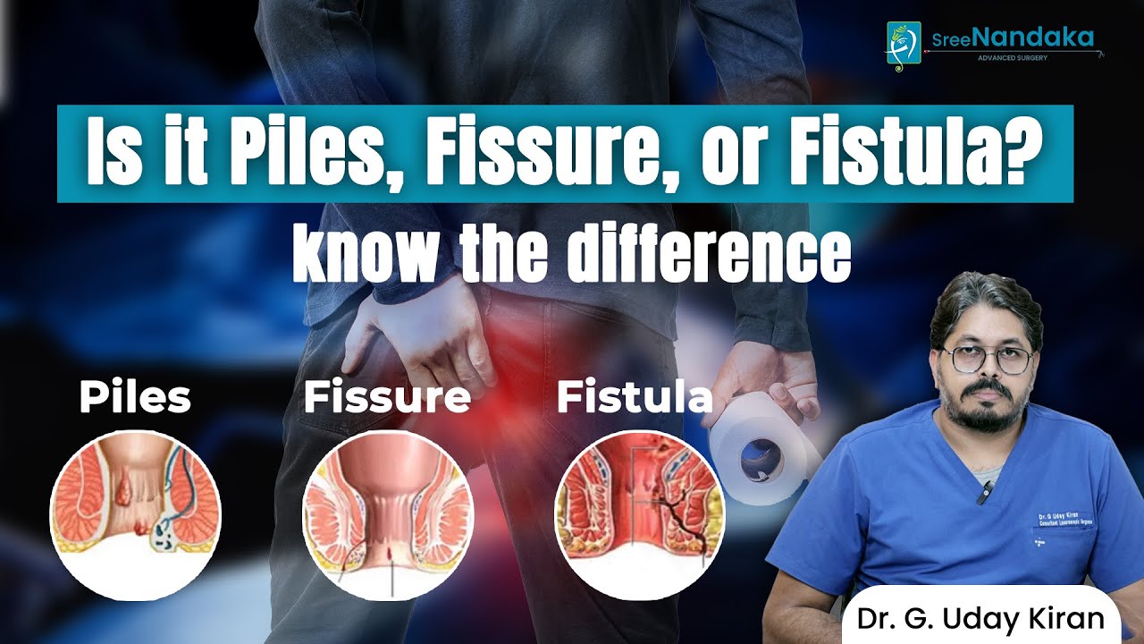 Piles, fissure & fistula — causes, symptoms and treatment