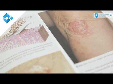 Die Creme ф99 bei der Schuppenflechte die Rezensionen Die Salbe mit gortschizej von der Schuppenflechte