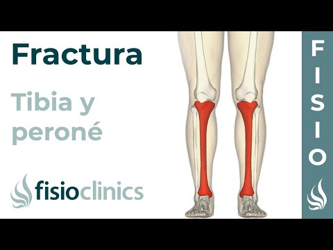 FRACTURA de TIBIA y PERONÉ Rehabilitación ejercicios y tiempo de recuperación- FisioClinics Palma