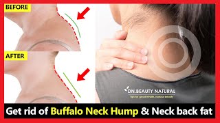 (Work 100%) How to get rid of Neck Hump, fix buffalo neck hump, fix back neck fat | 3 Easy Exercises