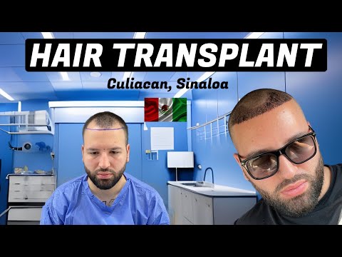 I went to Mexico for a hair transplant 💉🇲🇽