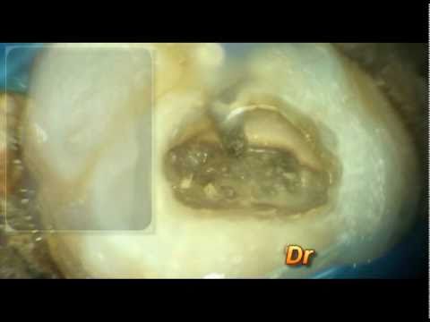 Che tipo di medicina per la prostatite cronica Warmer per la prostata
