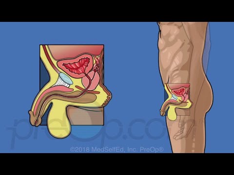 Adenoma centrale della prostata