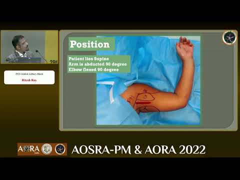 PNS guided Axillary brachial plexus block