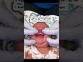 3 Signs of a Potential Tongue Tie