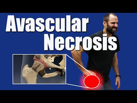 Hip Avascular Necrosis (AVN): Early Diagnosis, Treatment, and Rehab Protocols