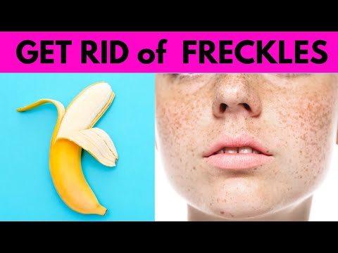 how to get rid of freckles Naturally fast ( Proven...