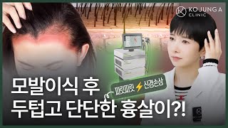 [ENG] 탈모, 모발이식 수술 부작용, 어떻게 치료해야 할까요? How to treat side effects of hair transplantation for hair loss