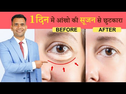 1 दिन में आंखो की सूजन से छुटकारा | Puffy Eyes Home Remedy | Quick Remedy for puffy eyes