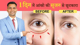 1 दिन में आंखो की सूजन से छुटकारा | Puffy Eyes Home Remedy | Quick Remedy for puffy eyes