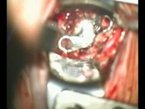 I metodi tradizionali di trattamento di acne sul retro Un dolore sordo nellintestino inferiore della schiena