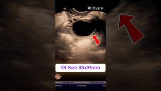 Download lagu FOLLICULAR CYST - ULTRASOUND | 14th Day Follicle Tracking  #ultrasound #infertility #ovulation mp3